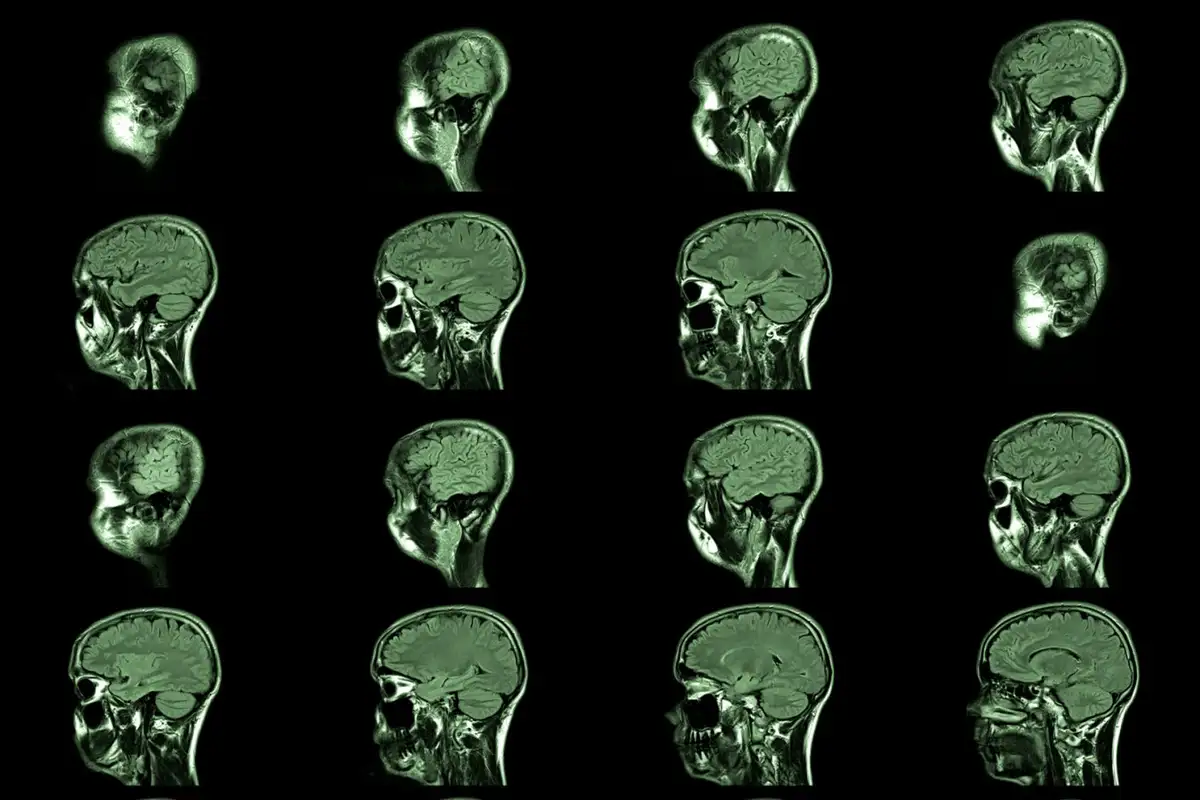 Does Cannabis Impact Memory